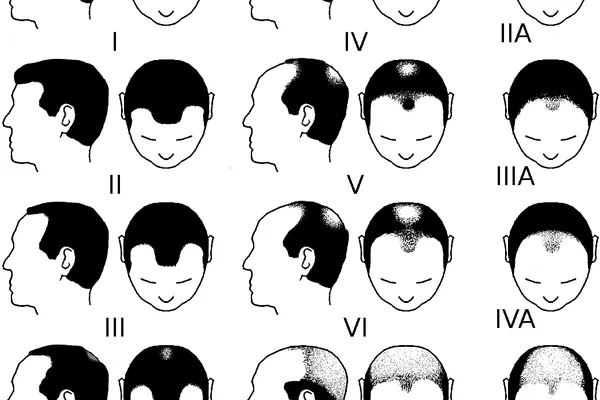 Perte de Cheveux : Solutions 2026 en Tunisie